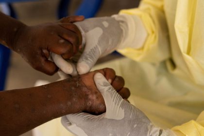 mpox:-saiba-quais-doencas-ja-tiveram-mais-alto-nivel-de-alerta-global