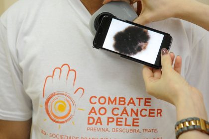 mutirao-atende-populacao-hoje,-no-dia-de-combate-ao-cancer-de-pele