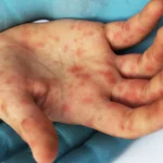 surto-de-sarampo-deixa-2-mortos-e-mais-de-200-doentes-nos-eua