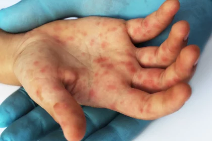 surto-de-sarampo-deixa-2-mortos-e-mais-de-200-doentes-nos-eua