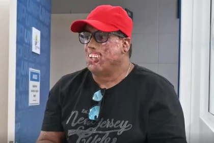 homem-com-doenca-rara-passa-por-230-cirurgias-no-rosto-e-ganha-protese