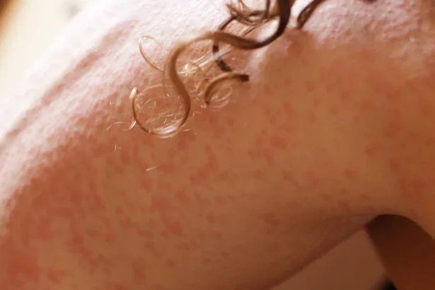 brasil-registra-primeiro-caso-de-infeccao-por-fungo-altamente-transmissivel