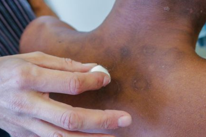 ia-criada-por-brasileiros-avalia-risco-de-agravamento-da-hanseniase