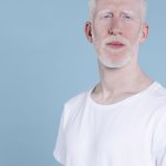 sancionada-lei-que-cria-politica-de-protecao-a-pessoas-com-albinismo