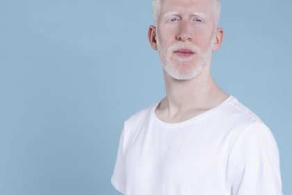 sancionada-lei-que-cria-politica-de-protecao-a-pessoas-com-albinismo