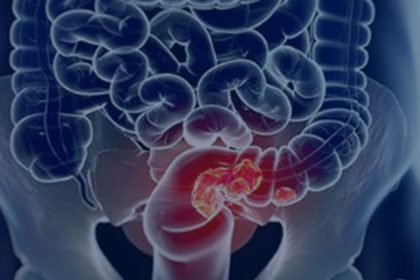 estudo-projeta-aumento-de-36%-em-mortes-por-cancer-colorretal-ate-2040