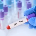 estudo-reforca-ligacao-entre-virus-epstein-barr-e-esclerose-multipla
