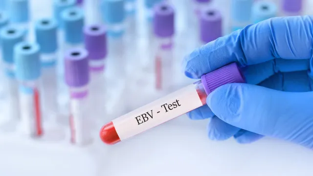 estudo-reforca-ligacao-entre-virus-epstein-barr-e-esclerose-multipla