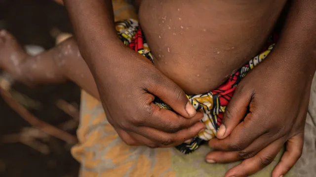 angola-regista-surto-de-mpox-com-dois-obitos-em-442-casos-desde-2024