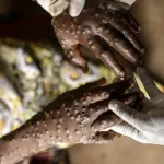 angola-regista-19-novos-casos-de-mpox-nas-ultimas-24-horas