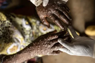 angola-regista-19-novos-casos-de-mpox-nas-ultimas-24-horas