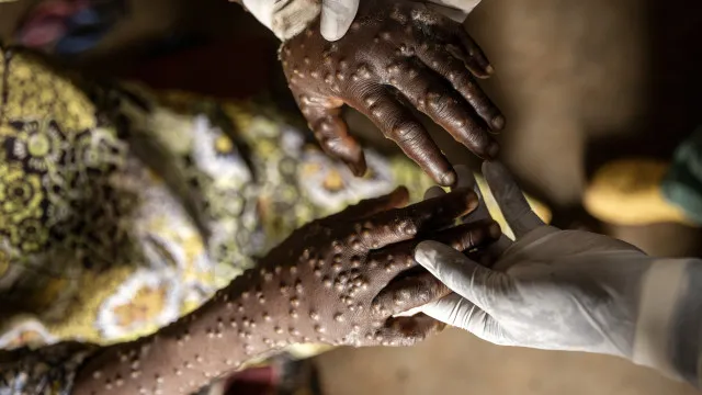 angola-regista-19-novos-casos-de-mpox-nas-ultimas-24-horas