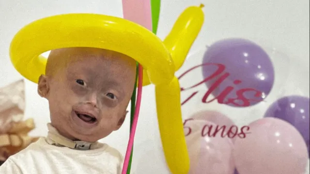 “nao-e-o-fim”.-morreu-gemea-com-sindrome-rara-que-causa-envelhecimento